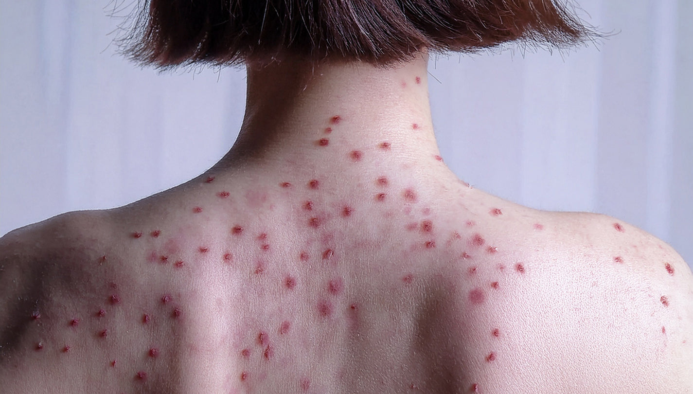 how to treat and eliminate acne and achieve clearer skin with Celluma LED therapy in Singapore