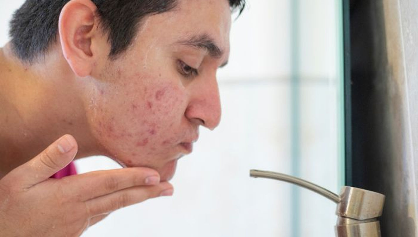 Clear Acne and Reduce Breakouts with FDA-Cleared Celluma HOME Blue & Red Light Therapy in Singapore