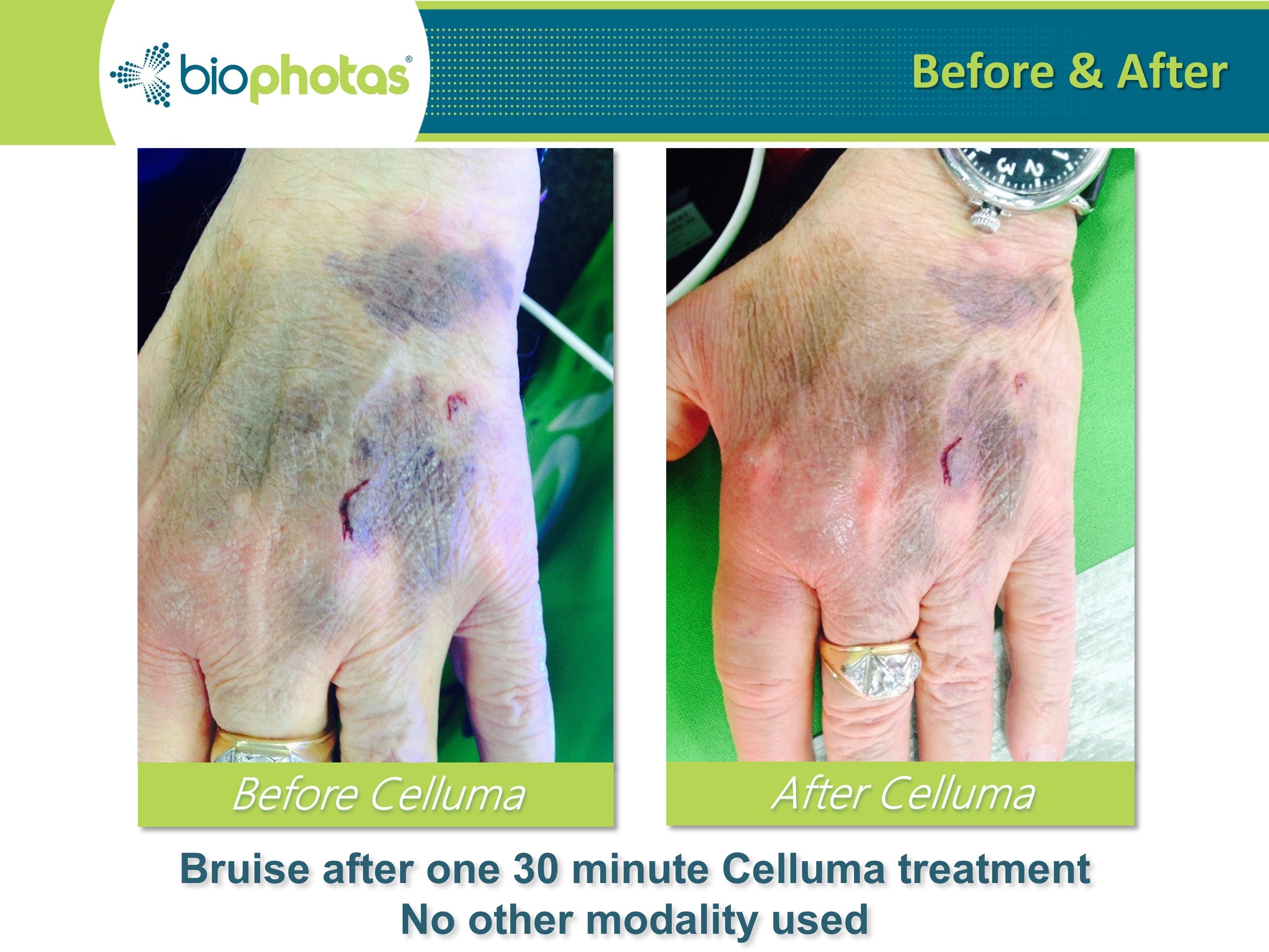 An FDA-cleared Celluma PRO panel contoured closely over skin tissue to accelerate the proliferation stage of post-surgical healing.