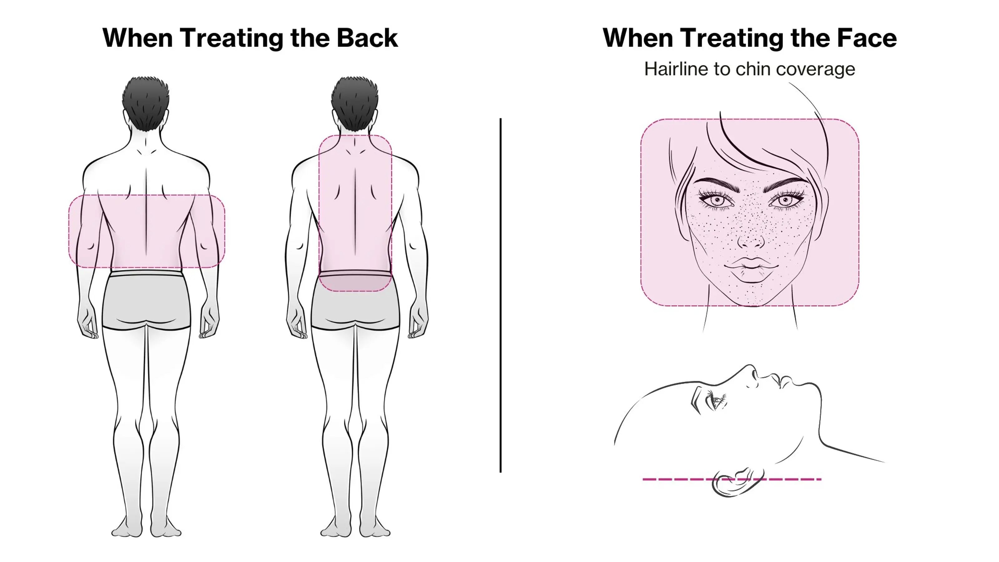 The Celluma PRO LED panel positioned for lower back pain relief. Utilizing the FDA-cleared 'Aches & Pains' mode, the device delivers deep-penetrating near-infrared light and red light to the lumbar region. The patented flexible design ensures the 353 LEDs remain within 1 inch of the skin for maximum ATP production and inflammation reduction.