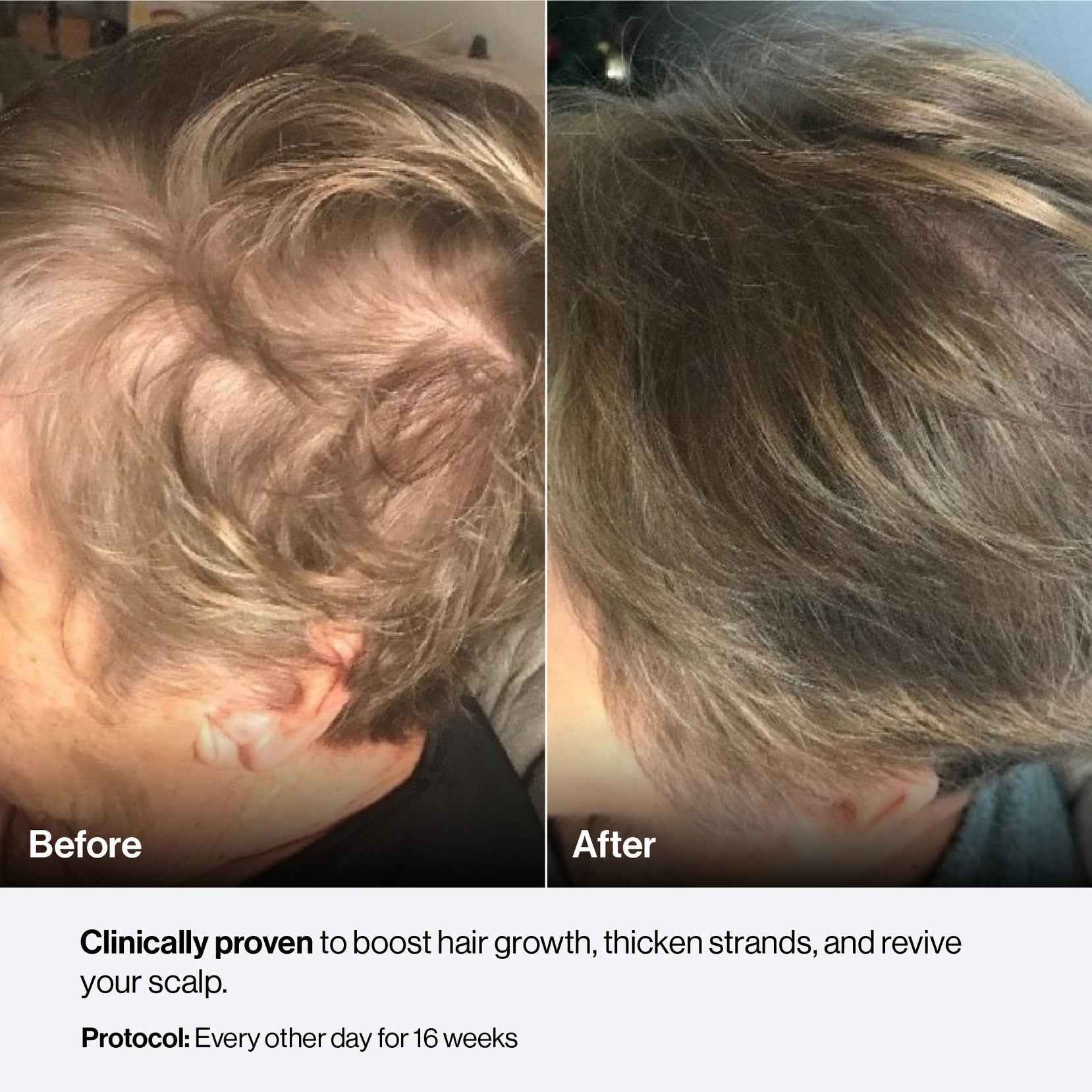 A woman using Celluma NOVA Led Red Light Therapy for hair growth.