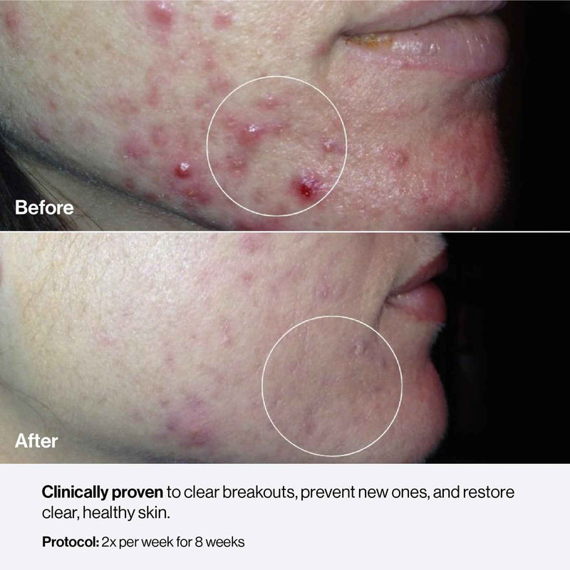 Before-and-after facial skin photos in a Celluma acne treatment graphic