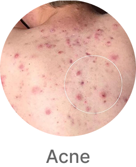 Acne on skin with 'Acne' label